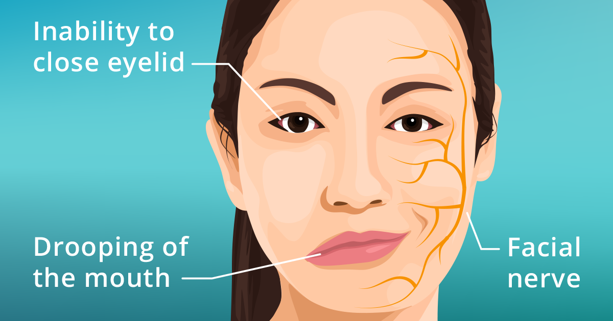 bells palsy